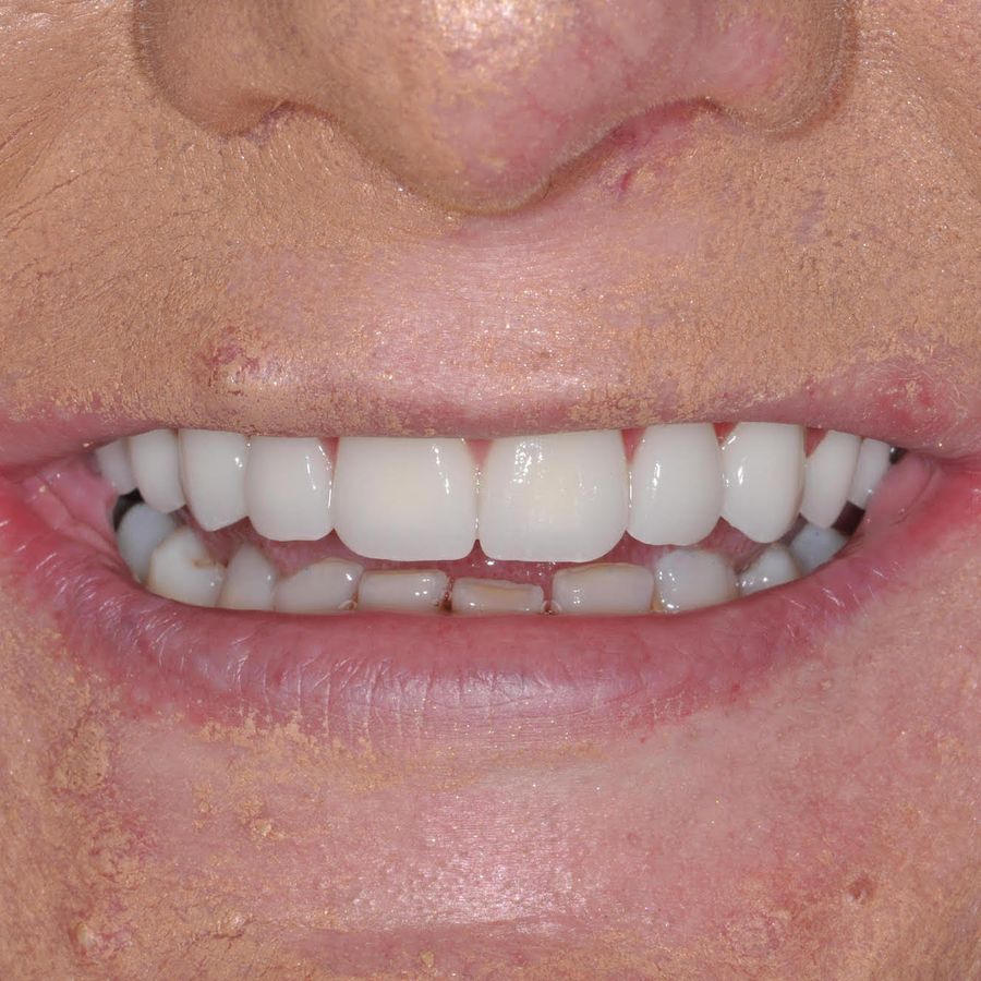 paula cronnelly - smile in a day - after - 3Dental